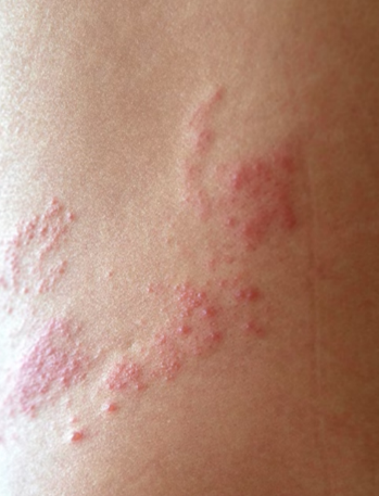  硬膜外ブロックとは